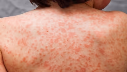 ഇത് കൊറോണയുടെ പുതിയ ലക്ഷണമോ? പരിഭ്രാന്തി പരത്തി കുട്ടികളുടെ ആരോഗ്യനില!