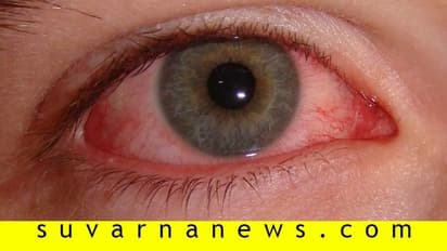 Madras Eye : வேகமெடுக்கும் மெட்ராஸ்-ஐ பரவல்! - தெரிந்துகொள்ள வேண்டிய தடுப்புமுறைகள்!