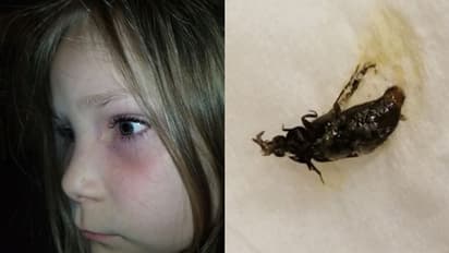 শিশুর চোখের ভিতরে আটকে জ্যান্ত গুবরে পোকা, ছবি দেখে হতবাক নেটিজেনরা