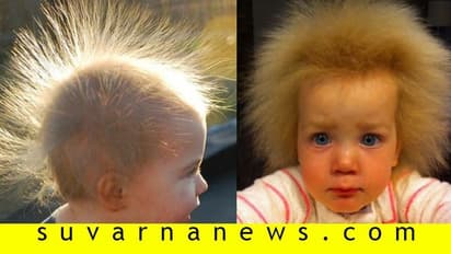 ಈ ಸಮಸ್ಯೆ ಇರುವವರು ಜಗತ್ತಿನಲ್ಲಿ ಹತ್ತಿರತ್ತಿರ ನೂರು ಮಂದಿ ಮಾತ್ರ!