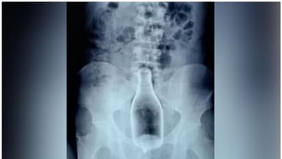 ലഹരി മൂത്ത് മദ്യക്കുപ്പി സ്വന്തം മലദ്വാരത്തില് കയറ്റി യുവാവ്; പുറത്തെടുത്ത് ശസ്ത്രക്രിയയിലൂടെ