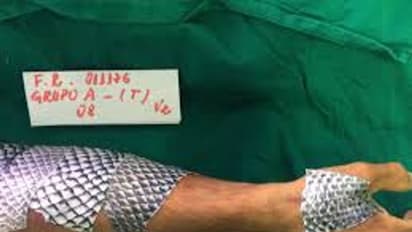 மீன் தோல் வைத்து தீ காயத்திற்கு சிகிச்சை! வியக்க வைக்கும் மருத்துவ முறை புகைப்பட தொகுப்பு!