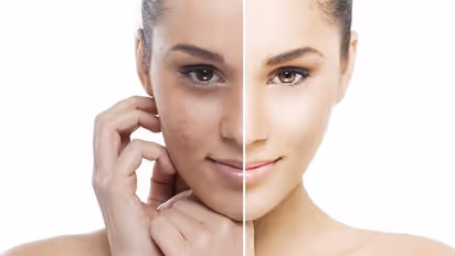 Homemade Face Pack : മുഖത്തെ കറുത്തപാടുകൾ മാറാൻ നാല് ചേരുവകൾ കൊണ്ടൊരു ഫേസ് പാക്ക്