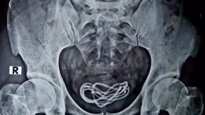 സഹിക്കാനാവാത്ത വയറുവേദന; പരിശോധനയിൽ‌ മൂത്രസഞ്ചിയിൽ നിന്ന് കണ്ടെത്തിയത് മൊബൈൽ ഫോൺ ചാർജർ കേബിൾ