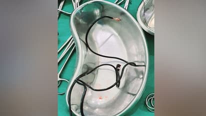 షాకింగ్.. 15యేళ్ల బాలుడి పొట్టలో... మూడు అడుగుల పొడవైన ఛార్జింగ్ కేబుల్...!!