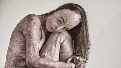 ಶೇ. 85ರಷ್ಟು ಸುಟ್ಟೋದ್ರು ಈ ಮಾಡೆಲ್, ನ್ಯೂಡ್ ಫೋಟೋಶೂಟ್ ಮಾಡಿ ತೋರ್ಸಿದ್ರು ಸುಟ್ಟ ದೇಹ!