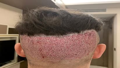 सावधान! हेयर ट्रांसप्लांट ने ली युवक की जान, आप भी ट्रीटमेंट के दौरान ना करें ये भूल