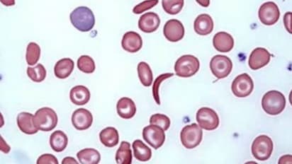 Anemia In Men : ಪುರುಷರಲ್ಲಿ ಅನೀಮಿಯಾ ಸಮಸ್ಯೆ, ಈ ಲಕ್ಷಣಗಳನ್ನು ಇಗ್ನೋರ್ ಮಾಡ್ಬೇಡಿ