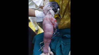 ಗಂಗಾವತಿ: ಒಂದೇ ಕಾಲಿರುವ ಅಪರೂಪದ ಮಗು ಜನನ..!