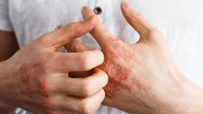 തൊലിപ്പുറത്ത് കാണുന്ന ചൊറിയുള്പ്പെടെയുള്ള പ്രശ്നങ്ങള്; കാരണം ഇതാകാം...