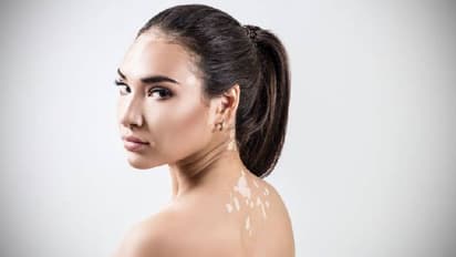 ഇന്ന് ലോക വെള്ളപ്പാണ്ട് ദിനം; അറിയാം ഈ രോഗലക്ഷണങ്ങള്...