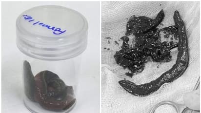 കഠിനമായ വേദനയുമായെത്തിയ വൃദ്ധന്റെ ലിംഗത്തിനുള്ളിൽ നിന്നും നീക്കം ചെയ്തത് അട്ടയെ