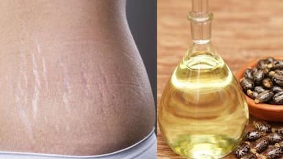 സ്ട്രെച്ച്മാർക്സ് മാറാൻ ആവണക്കെണ്ണ; അറിയാം മറ്റ് ഗുണങ്ങള്...