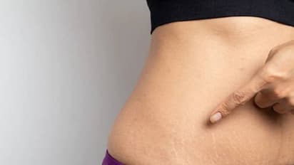 പ്രസവശേഷമുളള സ്ട്രെച്ച് മാർക്ക് മാറാൻ പരീക്ഷിക്കാം ഈ എളുപ്പ വഴികൾ...