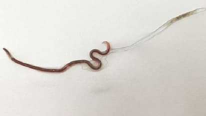 കടുത്ത തൊണ്ടവേദനയുമായെത്തിയ യുവതിയുടെ തൊണ്ടയില് നിന്ന് ഡോക്ടര്മാര് പുറത്തെടുത്തത്...