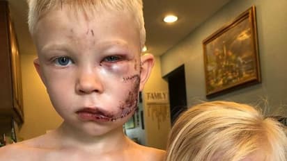 చెల్లి కోసం కుక్కతో పోరాడిన 6ఏళ్ల బుడతడు, ముఖంపై 90 కుట్లు...