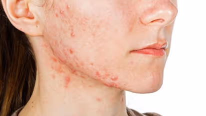 സ്ത്രീകളില്‍ അസാധാരണമായി മുഖക്കുരു വരുന്നതിനുള്ള ഒരു കാരണം...