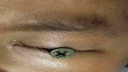 ತಂದೆ ಮಾಡಿದ ಒಂದು ಎಡವಟ್ಟು, ಮಗನ ಕಣ್ಣಿಗೆ ಹೊಕ್ಕ ಮೊಳೆ!