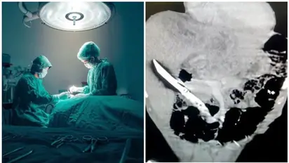 Man who swallowed knife lived with it for over a month; doctors successfully remove sharp object