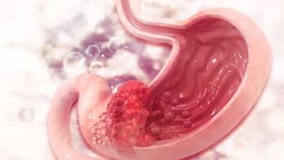 ಪಿನ್ ವರ್ಮ್: ಈ ಕರುಳಿನ ಸೋಂಕಿಗೆ ಚಿಕಿತ್ಸೆ ನೀಡಲು ಸುಲಭ ಮನೆಮದ್ದು ಇಲ್ಲಿದೆ