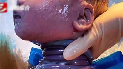 ಗರ್ಭದಲ್ಲೇ 'ನೇಣು' ಬಿಗಿದುಕೊಂಡ ಕಂದ, ವೈದ್ಯರು ಹೀಗೆ ಹೊರಗೆಳೆದರು!