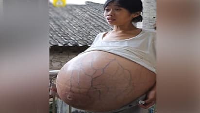 রহস্যজনক ভাবে বেলুনের মতো ফুলে চলেছে পেট, কারণ জানা নেই চিকিৎসকদেরও