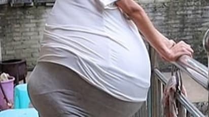 பலூன் போல் பெரிதாகி கொண்டே போகும் வயிறு... வினோத நோயால் அவதிப்படும் பெண்!