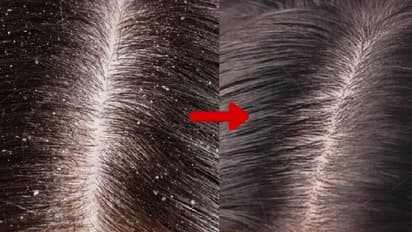 താരനോട് ഇനി 'ഗുഡ്ബൈ' പറയാം; വീട്ടില്‍ തയ്യാറാക്കാം ഈ ഹെയര്‍മാസ്ക് !