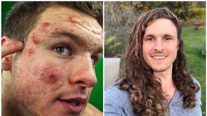 മുഖക്കുരു മാറാൻ ഈ ബോഡി ബിൽഡർ ഒഴിവാക്കിയത് രണ്ട് ഭക്ഷണങ്ങൾ