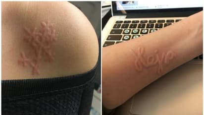 ആദ്യം തൊലി വീർക്കും, തൊടുമ്പോൾ ചുവപ്പാകും; വർഷങ്ങളായി യുവതിയെ അലട്ടുന്ന ഒരു അപൂർവ രോഗാവസ്ഥ