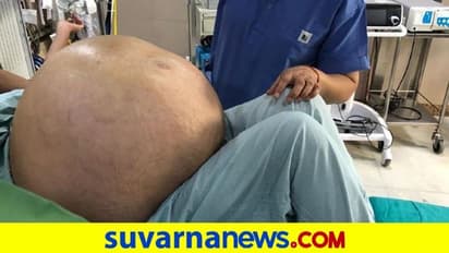 ಮಹಿಳೆಯ ದೇಹದಿಂದ 54 ಕೇಜಿ ತೂಕದ ಗಡ್ಡೆ ಹೊರಕ್ಕೆ!