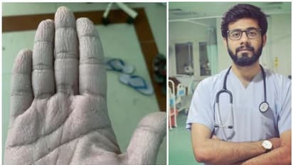 മണിക്കൂറുകളോളം പിപിഇ കിറ്റ് ധരിച്ച് ചുളുങ്ങിപ്പോയ കൈവെള്ളയുടെ ഫോട്ടോ ഇട്ട് ഡോക്ടർ, നന്ദി പറഞ്ഞ് സോഷ്യൽ മീഡിയ