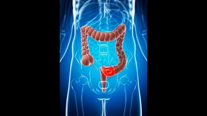 Health Tips: বাড়ছে কোলন ক্যান্সার, জেনে নিন আপনার কোন ভুলে এই রোগ শরীরে বাসা বাঁধতে পারে