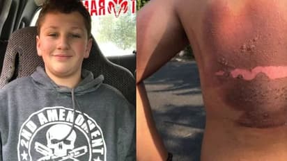 'പോര്‍ട്ടബിള്‍ ചാര്‍ജര്‍ പൊട്ടിത്തെറിച്ച് ഉറക്കത്തിനിടെ പതിനഞ്ചുകാരന് പൊള്ളലേറ്റു'