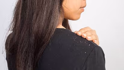 താരന് അകറ്റാന് വീട്ടില് പരീക്ഷിക്കാവുന്ന അഞ്ച് മാര്ഗങ്ങള്...