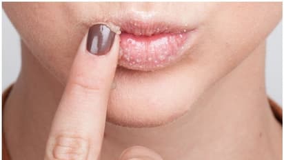 വരണ്ട ചുണ്ടുകൾ അകറ്റാൻ സഹായിക്കുന്ന 3 തരം ലിപ് സ്ക്രബുകൾ