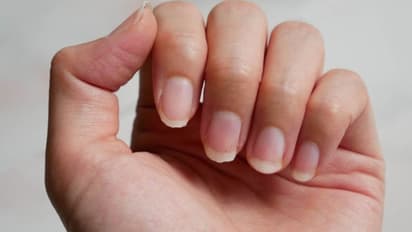 നഖങ്ങള്‍ കേടാകുന്നതും 'സ്‌കിന്‍ ഡ്രൈ' ആകുന്നതും; അറിയാം ഈ ആരോഗ്യപ്രശ്‌നം