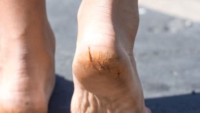 মরশুম বদলের আগেই নিন যত্ন, শীতকালে দূরে রাখুন পা ফাটার সমস্যা