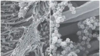ശ്വാസകോശത്തെ ബാധിച്ച കൊറോണ വൈറസിന്റെ ചിത്രങ്ങൾ പുറത്തുവിട്ട് ​ഗവേഷകര്‍