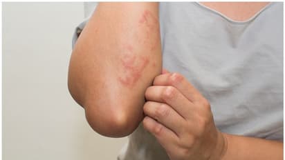 മാറാതെ നിൽക്കുന്ന ത്വക്ക് രോ​ഗങ്ങൾ, കാരണം മനസ്സിന്റെ ടെൻഷനാകാം; സൈക്കോളജിസ്റ്റ് എഴുതുന്നു