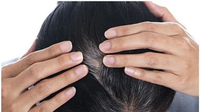 'അകാലനര' അകറ്റാൻ ഇതാ അഞ്ച് പൊടിക്കെെകൾ