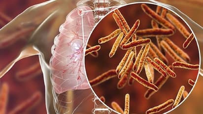 দেশে কয়েক লক্ষ মানুষ এই রোগে আক্রান্ত, জেনে নিন যক্ষা-র প্রাথমিক লক্ষণ ও প্রতিকার সম্পর্কে