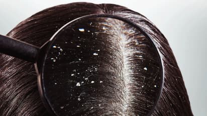 শীতের সময় চুলে খুশকি, দূর করুন এই ঘরোয়া টিপসে, মিলবে চটজলদি সমাধান