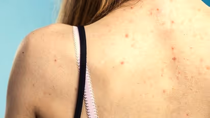 সাধের ব্যাকলেস পরতে বাধা হচ্ছে পিঠের এই দাগ, অব্যর্থ টোটকায় সারিয়ে উঠুন এই সমস্যা