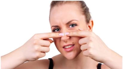 ഈ രണ്ട് ഫേസ് പാക്കുകൾ ഉപയോ​ഗിച്ച് 'ബ്ലാക്ക്ഹെഡ്സ്' ഈസിയായി അകറ്റാം