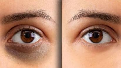 Dark Circle Problem: ఇలా చేస్తే డార్క్ సర్కిల్స్ తొందరగా తగ్గిపోతాయి..