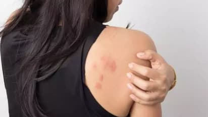 തൊലിപ്പുറത്ത് കാണുന്ന ചില മാറ്റങ്ങള്‍ ഈ രോഗത്തിന്റെ സൂചനകളാകാം...