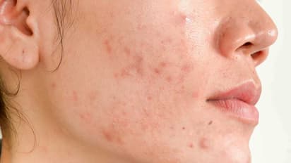 Tips to reduce acne scars and brighten your skin