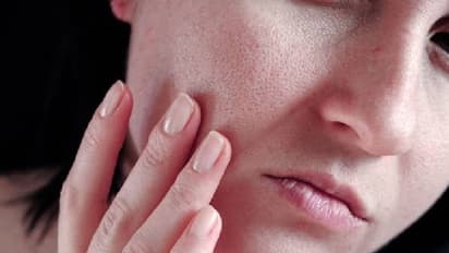 മുഖത്തെ കുഴികൾ മാറാന് പരീക്ഷിക്കാം ഈ നാല് വഴികള്...