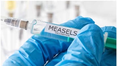 2021ൽ അഞ്ചാംപനി പൊട്ടിപ്പുറപ്പെടാൻ സാധ്യതയെന്ന് പഠനം